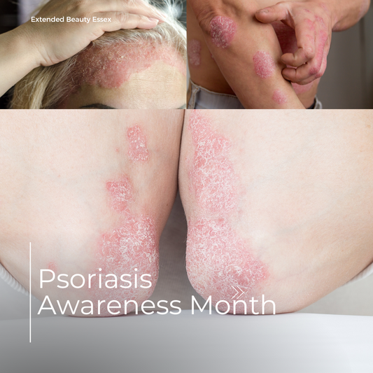 Empowering Lives: Shedding Light on Psoriasis During Awareness Month