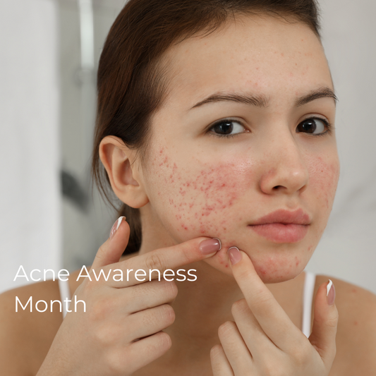 Understanding Acne: Tips for Clearing Up Your Skin During Acne Awareness Month